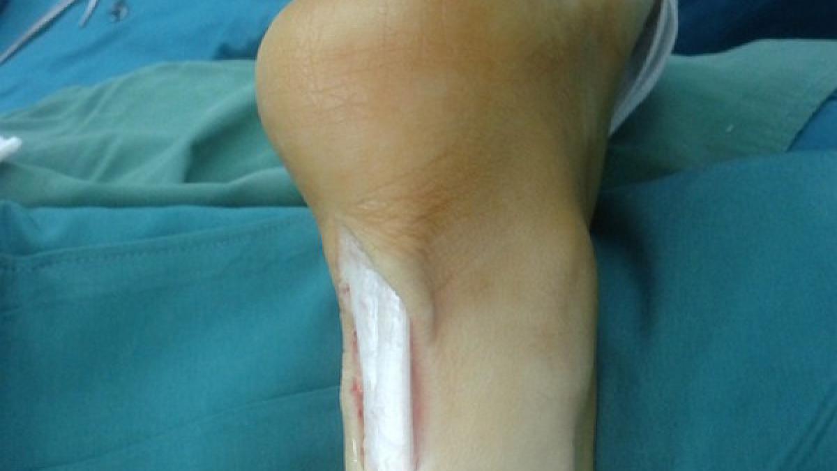 tendon_achile_ruptura_18132000