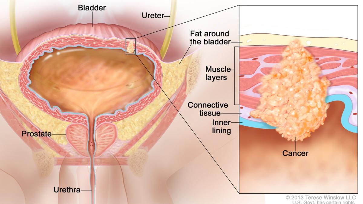 cancer_vezica_foto_terese_winslow_nih_65261500
