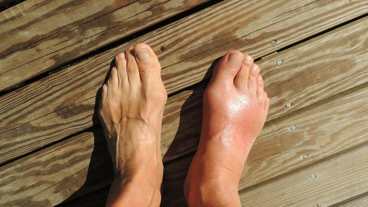 picioare_guta_inflamatie_reumatism_54486700