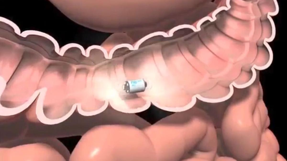 capsula_endoscopica_19615500