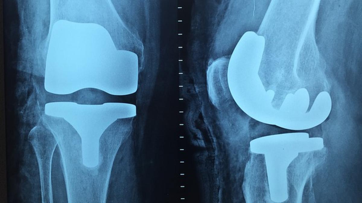radiografie_genunchi_proteza_31416800