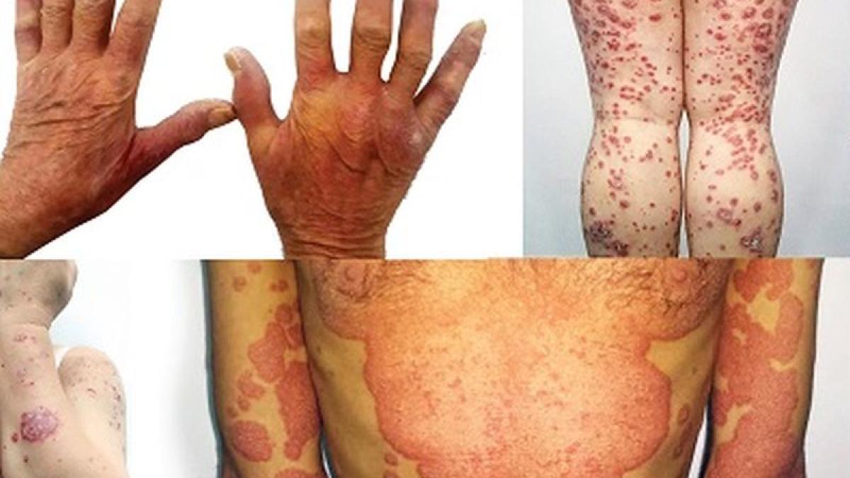 psoriazis_30090300