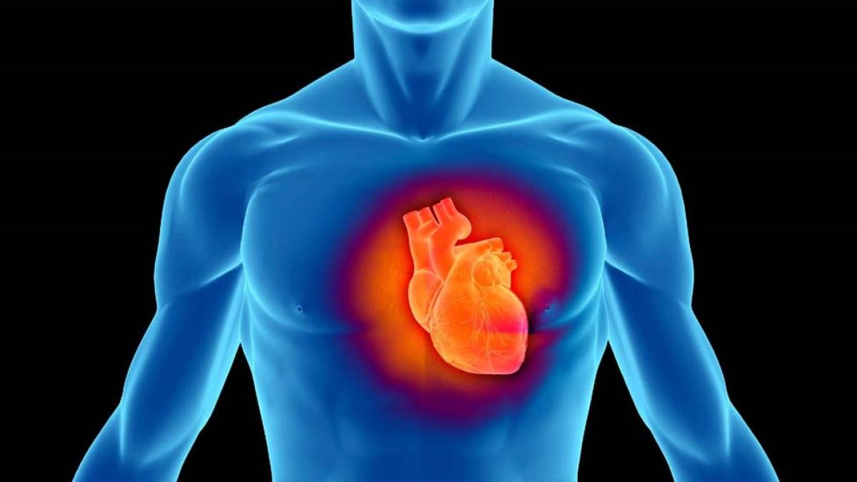 infarct_19815700