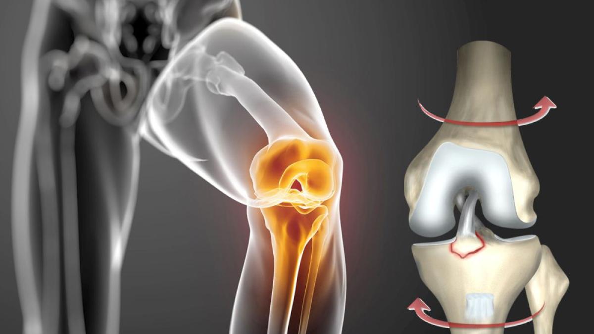 ruptura_ligament_incrucisat_foto_sanador_89654800