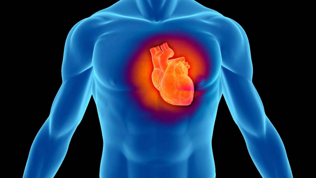 infarct_21714700