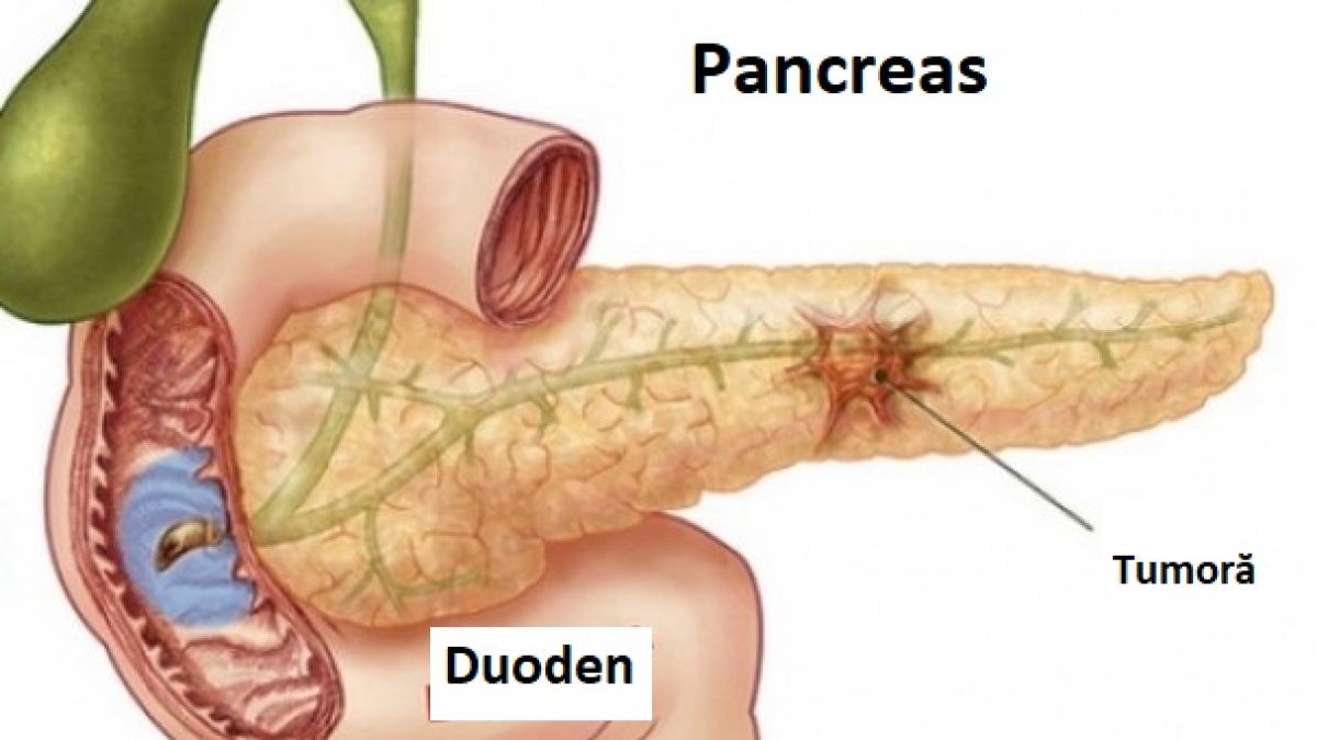 cancer_pancreas_40184600