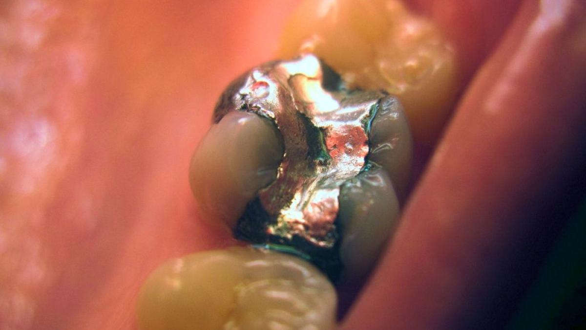 plombe_metalice_amalgam_foto_wikipedia_76622100