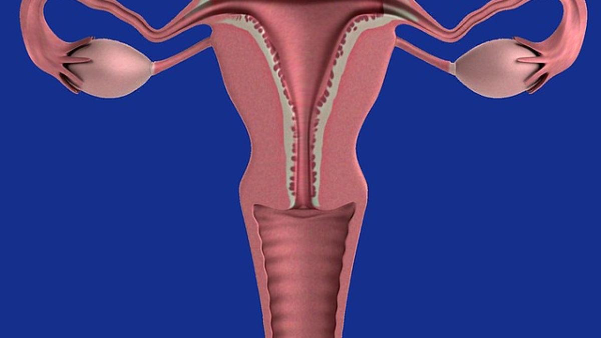 endometrioza_uter_72396300