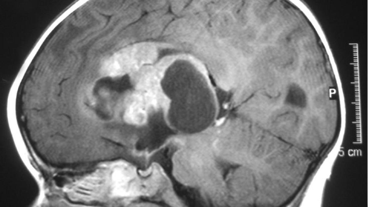733px_atrt_mri_08141700
