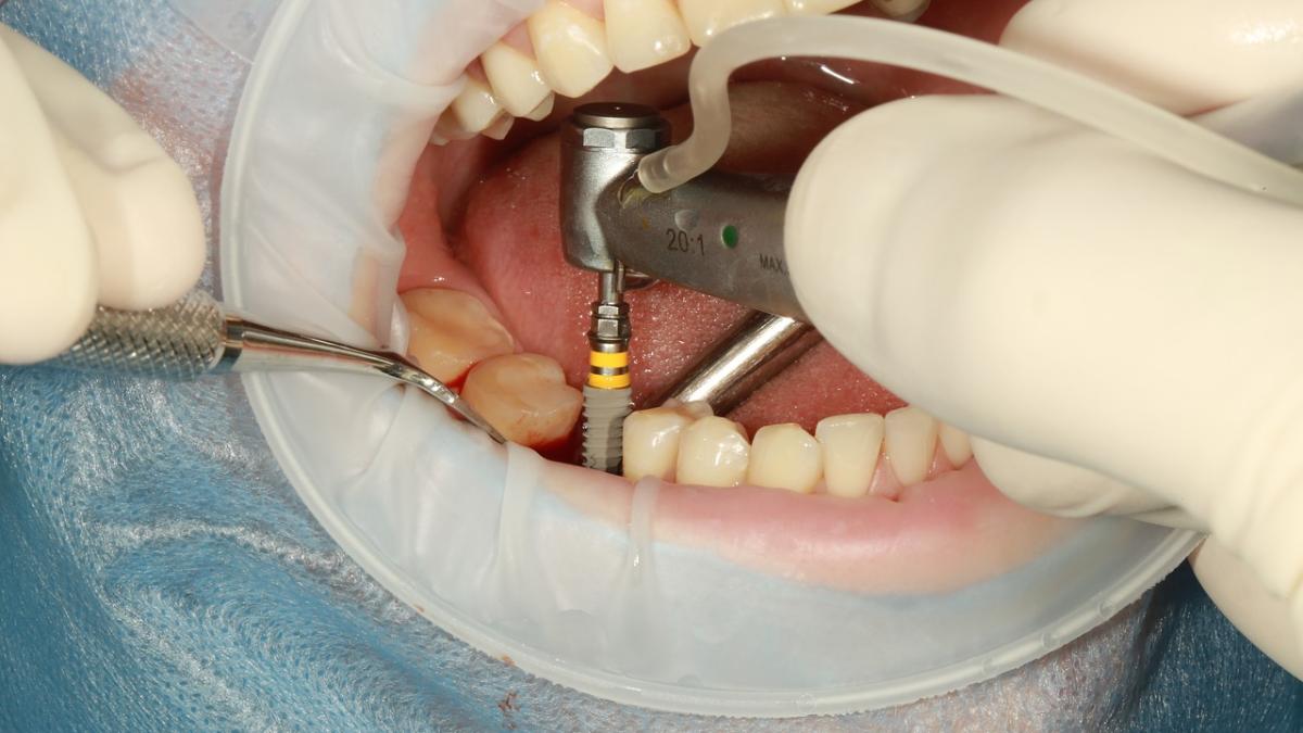 dental_implant_92704100