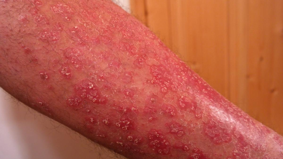 psoriasis_356429_1280_72419100