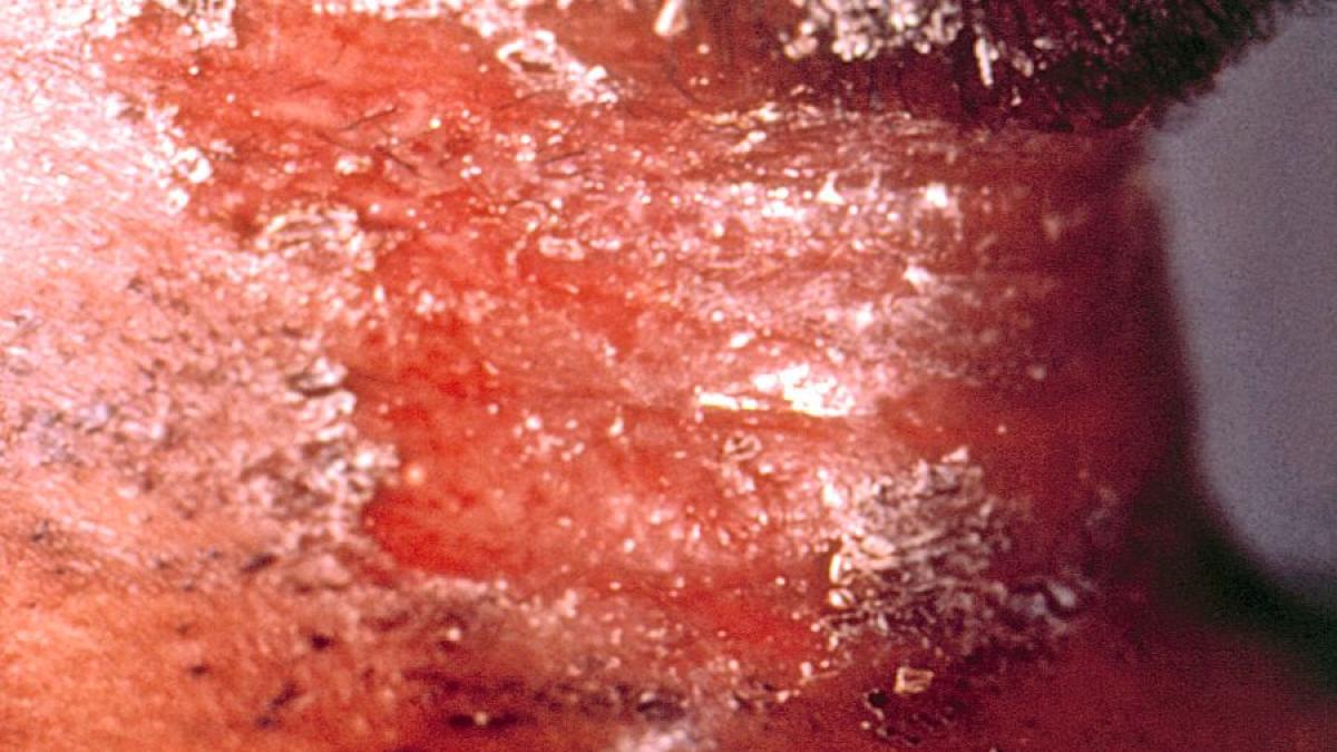 leziuni_difteria_foto_cdc_21382000