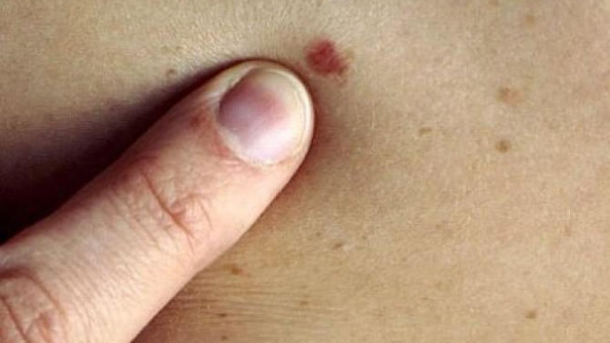 cancer_piele_29942600_90070400