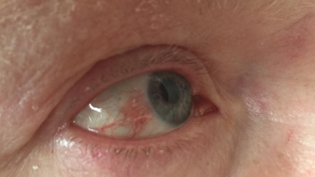 day08_shingles_or_herpes_zoster_virus_attacking_forehead_and_eye_44498100