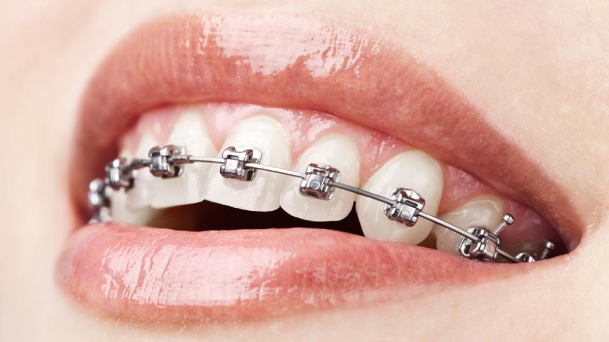 servicii_aparate_dentare_adulti_1000x658_49250200