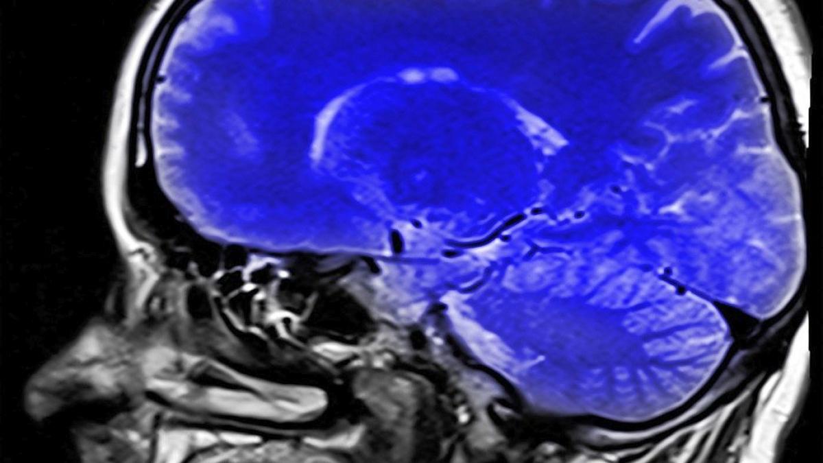 creier_avc_accident_vascular_cerebral_42966000