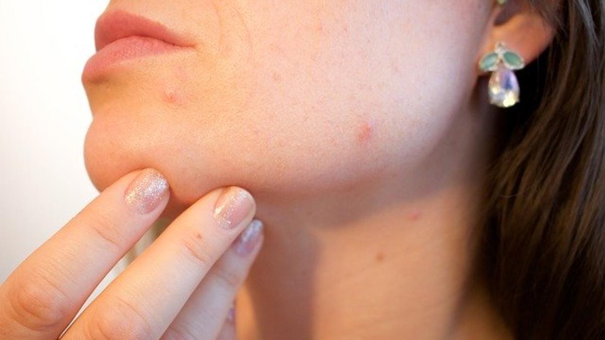 acne_1606765_640_45812300