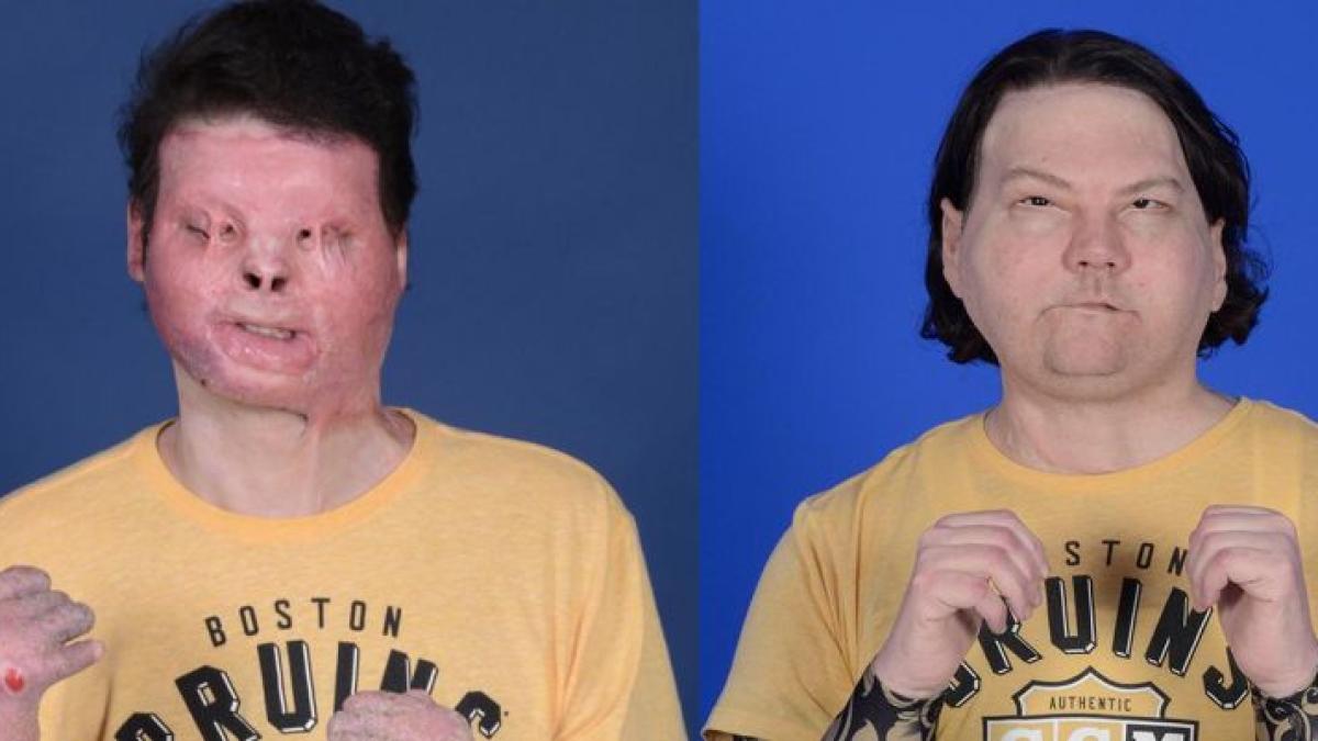 joe-dimeo--press-release-first-successful-face-and-double-hand-transplant_49091800