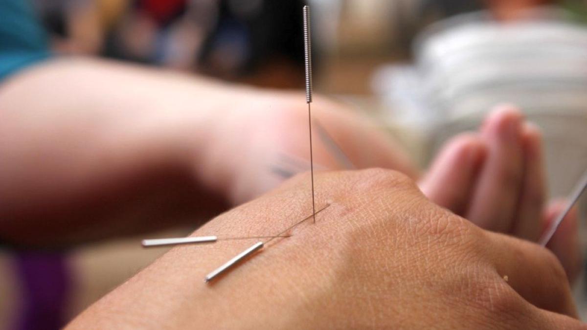 acupunctura-pixabay_31735600