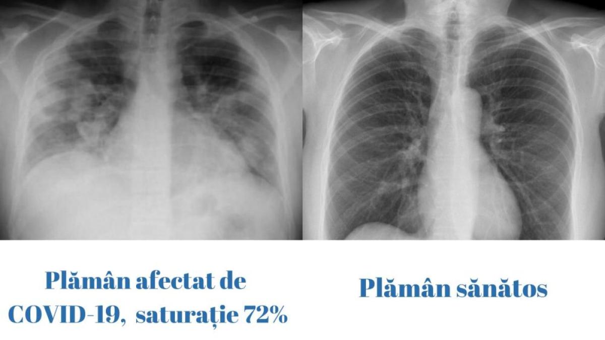 plaman-covid-rovaccinare_39734700