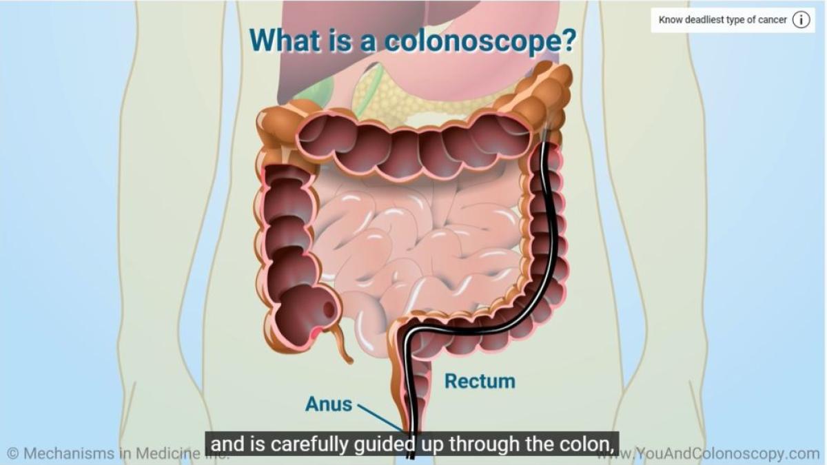 colonoscopie_30182700