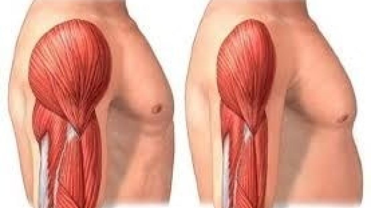 sarcopenia_54631700