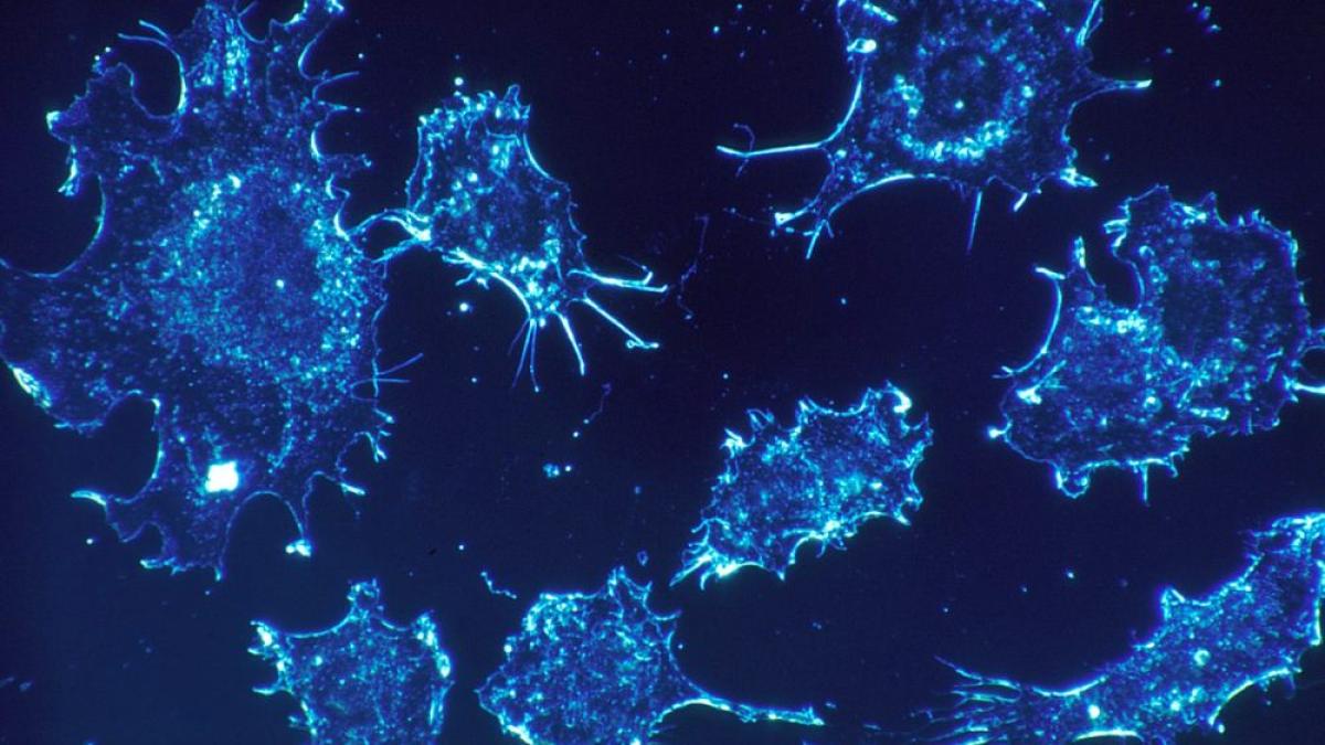 celule_cancer_pixabay_93207300