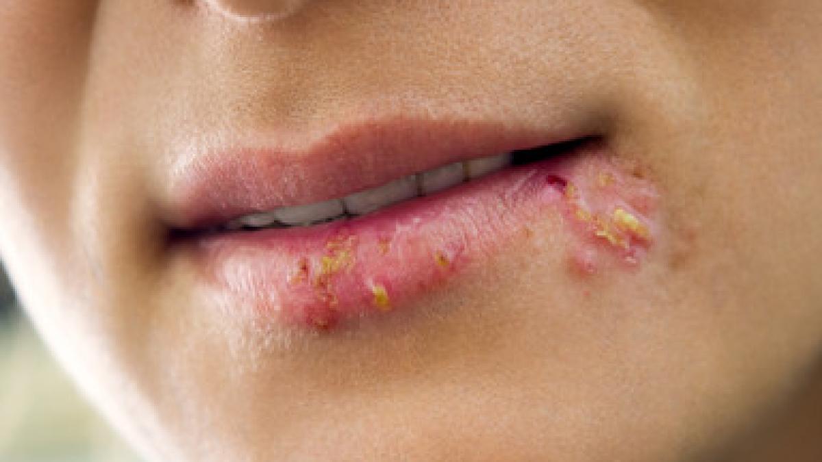 herpes--foto-freepik_74720700