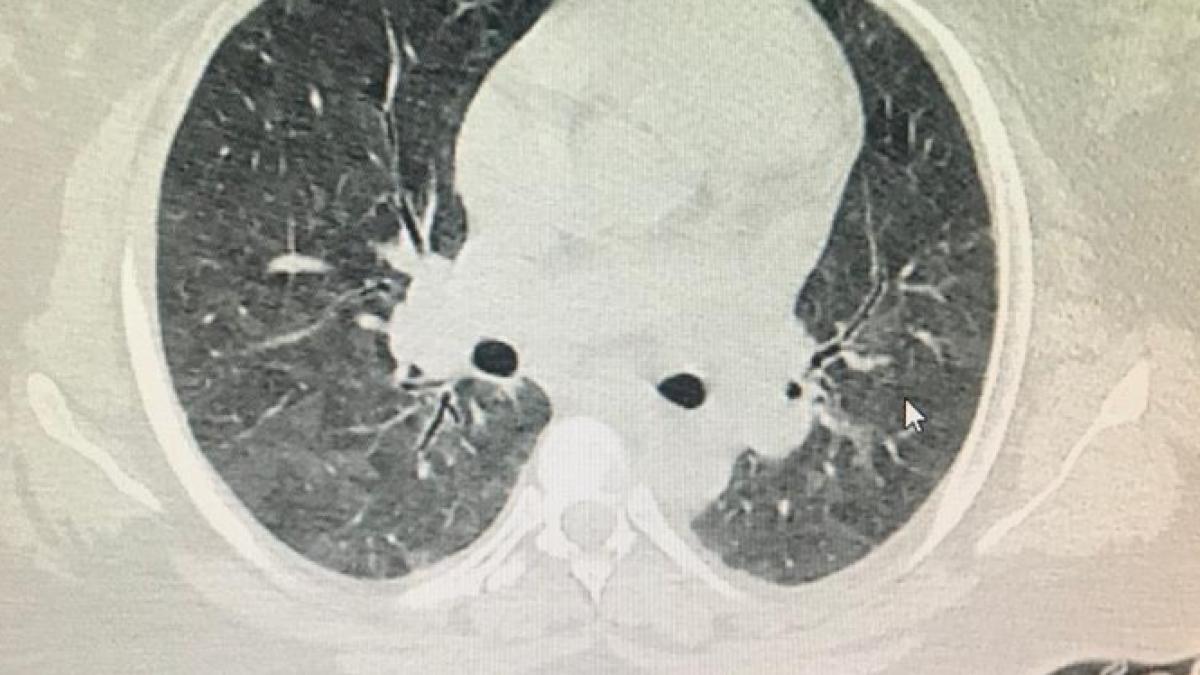 pneumonia-comunitara--val-mare-de-cazuri-in-spitale--dr--geru--despre-simptome-transmitere-foarte-ridicata--15prc--dintre-pacienti-mor_05134600