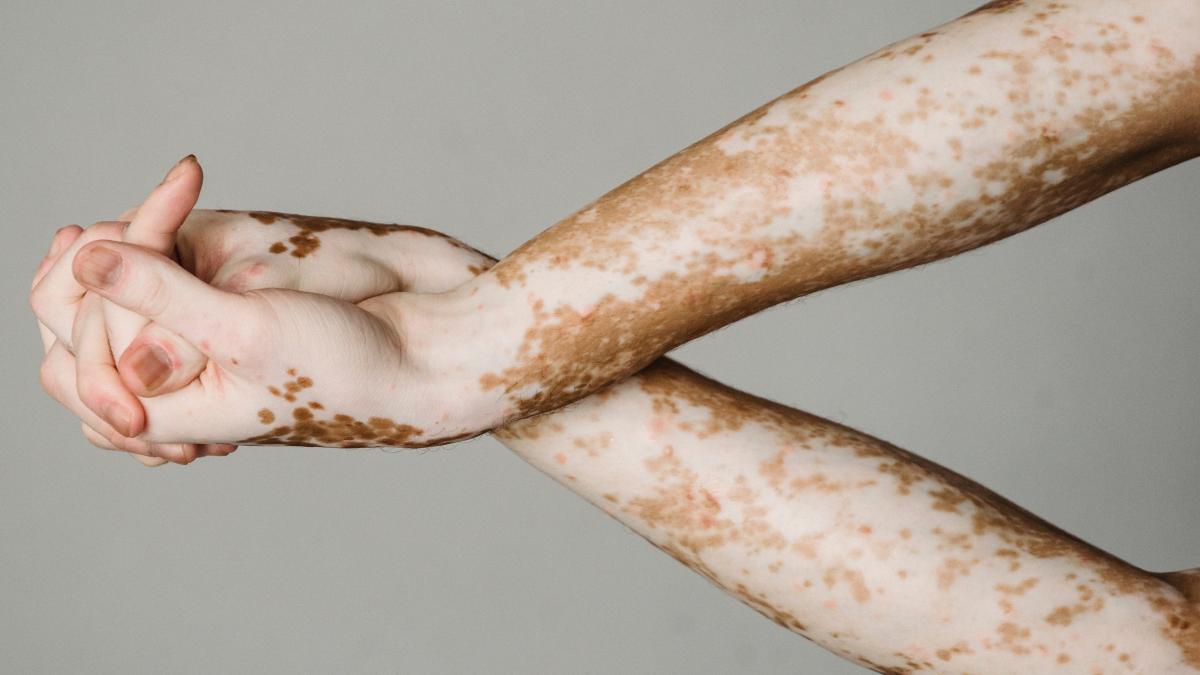 vitiligo_83427200