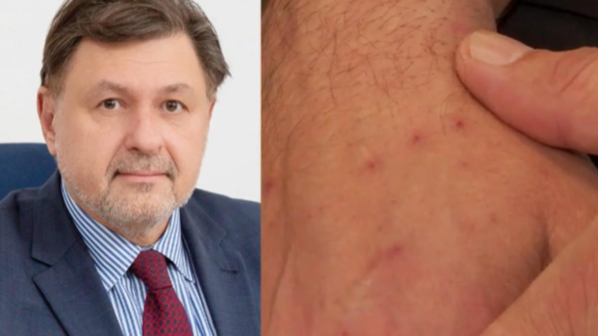 rafila--despre-o-posibila-pandemie-de-variola-maimutei-este-exclus-asa-ceva--riscul-de-infectie-este-mic_26029900