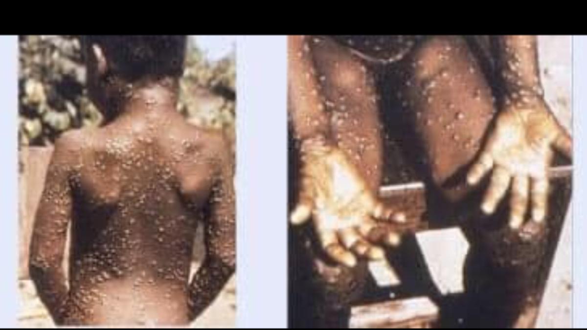 variola-maimutei--monkeypox--adevarul--lista-infectiilor-care-pot-provoca-pandemie-nu-e-vrajotorie--nu-e-previziune-de-a-lui-nostradamus_29804900