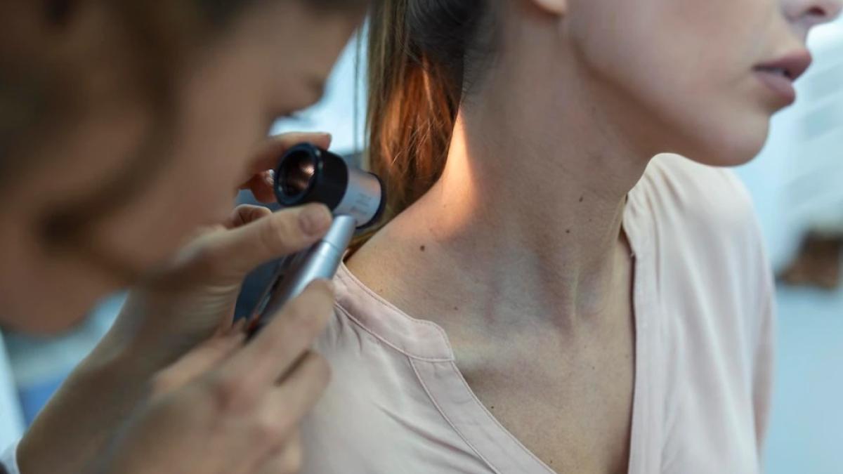 melanomul_53366900