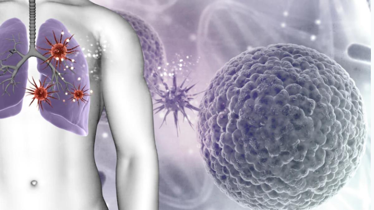 tehnica-ce-omoara-cancerul-pulmonar-se-necrozeaza--in-sase-luni-nu-se-mai-vede-deloc--pe-vremuri--chirurgia-clasica-inlocuia-intregul-plaman_85076400