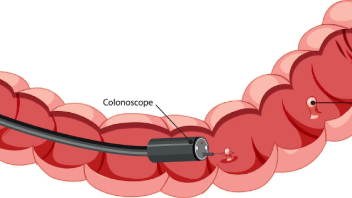cand-se-face-colonoscopia--florentina-ionita-radu-acum--se-face-sub-anestezie--pacientul-nu-stie-nimic_91641200