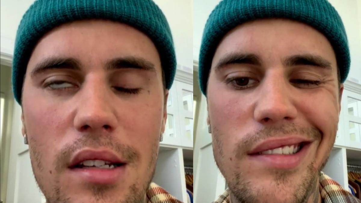 justin-bieber--paralizat-pe-jumatate-de-fata--ce-este-sindromul-ramsay-hunt-este-destul-de-grav--duce-la-pierderea-auzului_02993400
