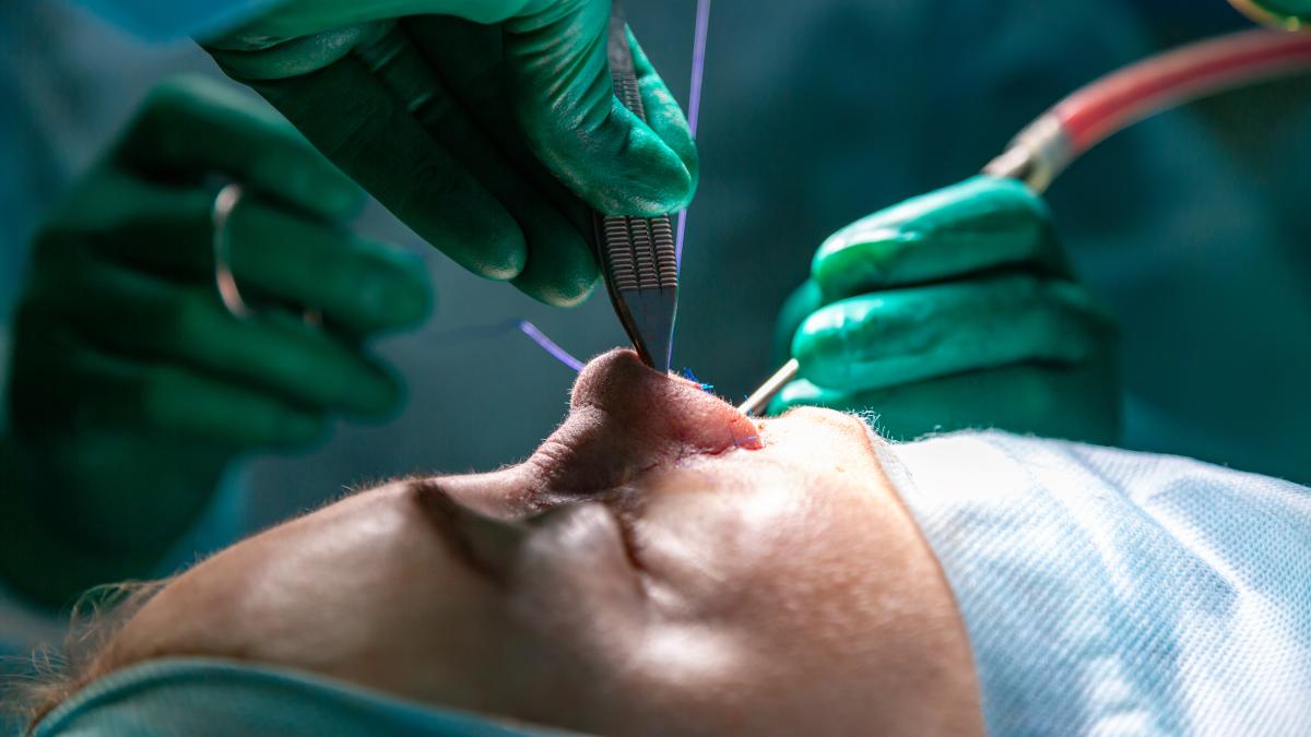 rinoplastia_32505700