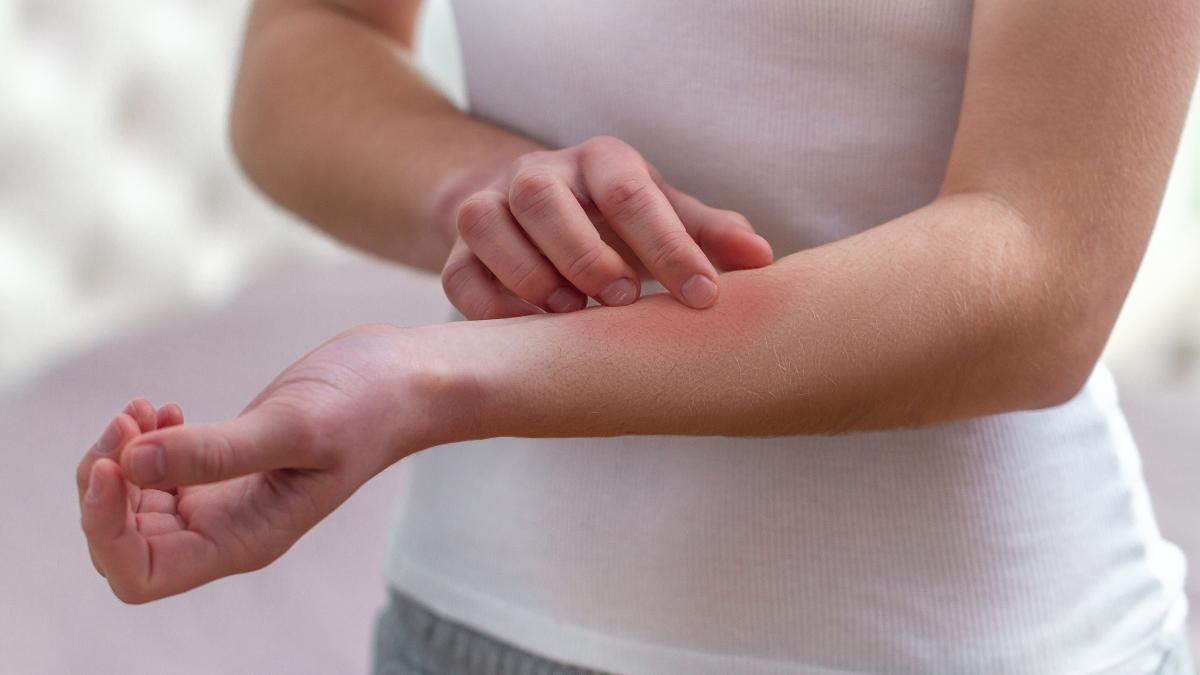 eczemele_04498100