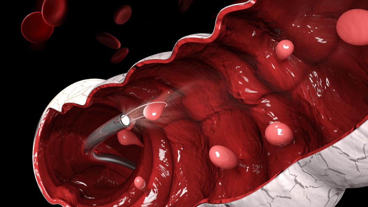 2-treimi-din-tumorile-endocrine--localizate-in-tractul-digestiv--poiana-au-fost-numite-carcinoide--dar-s-a-demonstrat-ca-aceste-tumori-pot-fi-cancere-adevarate_27837800
