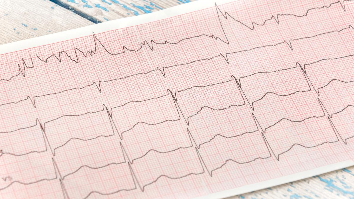 cum-recunosti-un-infarct-pe-ekg--ce-este-un-ekg--cand-trebuie-sa-l-faci-si-ce-inseamna-liniile-de-pe-electrocargiograma_78989900