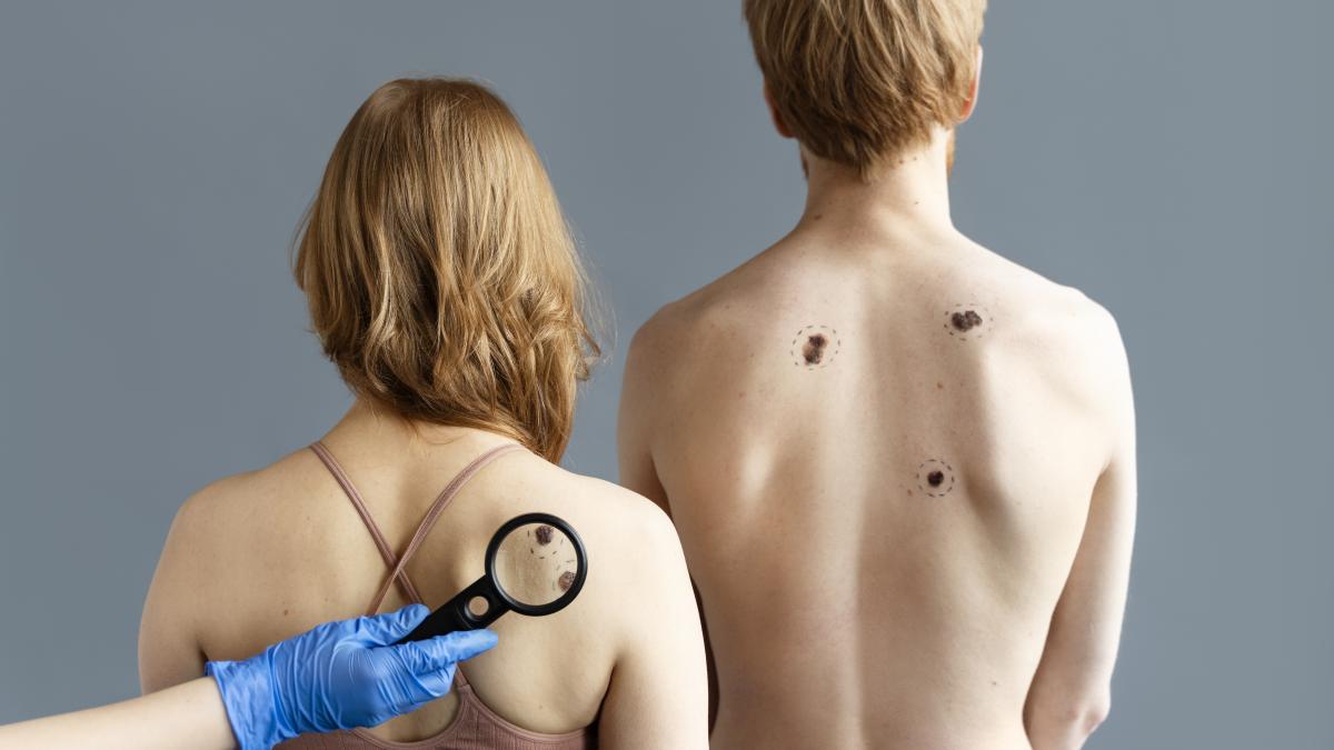 cand-este-necesar-screening-ul-pentru-cancerul-de-piele_25457600