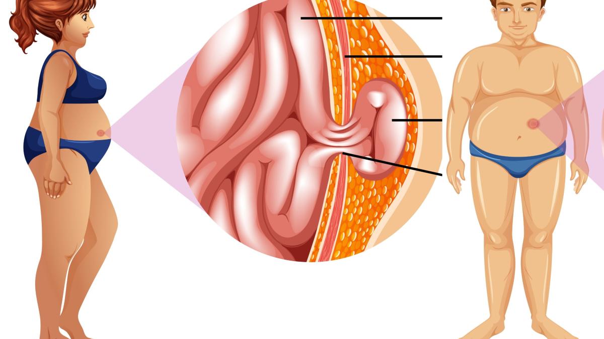 hernia-hiatala--cauze--simptome--tratament--care-e-legatura-cu-refluxul-gastroesofagian-o-poti-avea-si-sa-traiesti-fericit-pana-la-adanci-batraneti_48789400