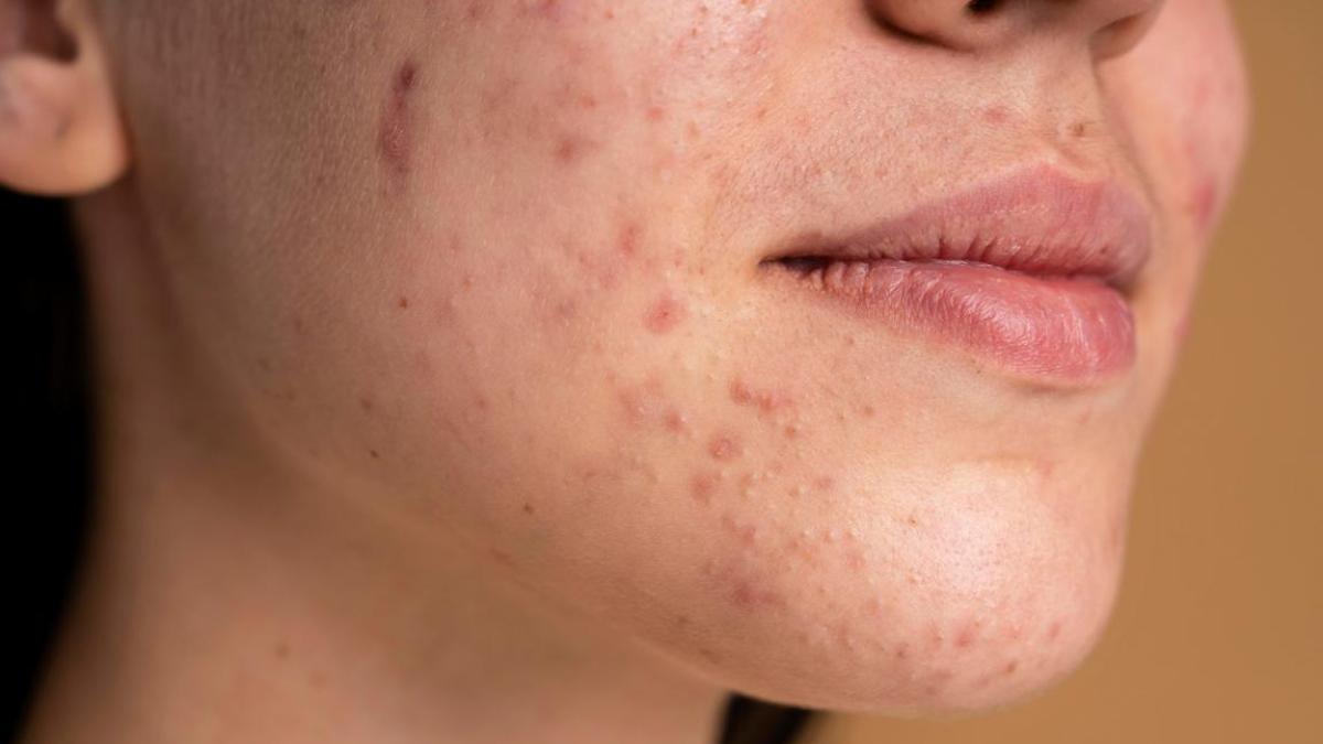acneea--ce-sa-nu-faci-niciodata-daca-o-ai_98322000