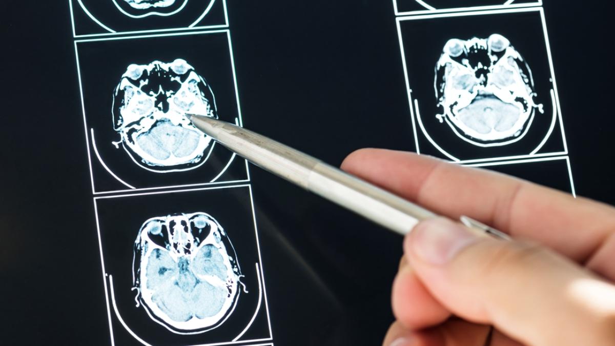 metastazele-cerebrale--tratament-revolutionar-cu-colorarea-procesului-tumoral--ghidat-de-neuronavigatie_88343700