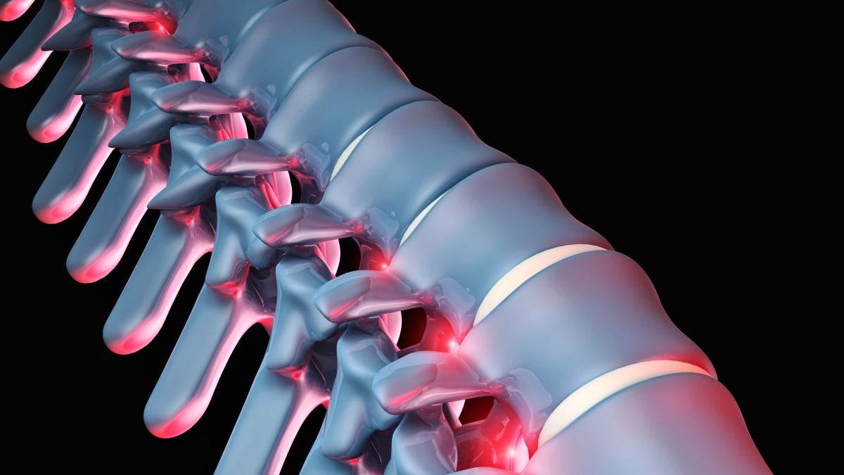 hernia-de-disc--cauze-si-tratatament_70153200