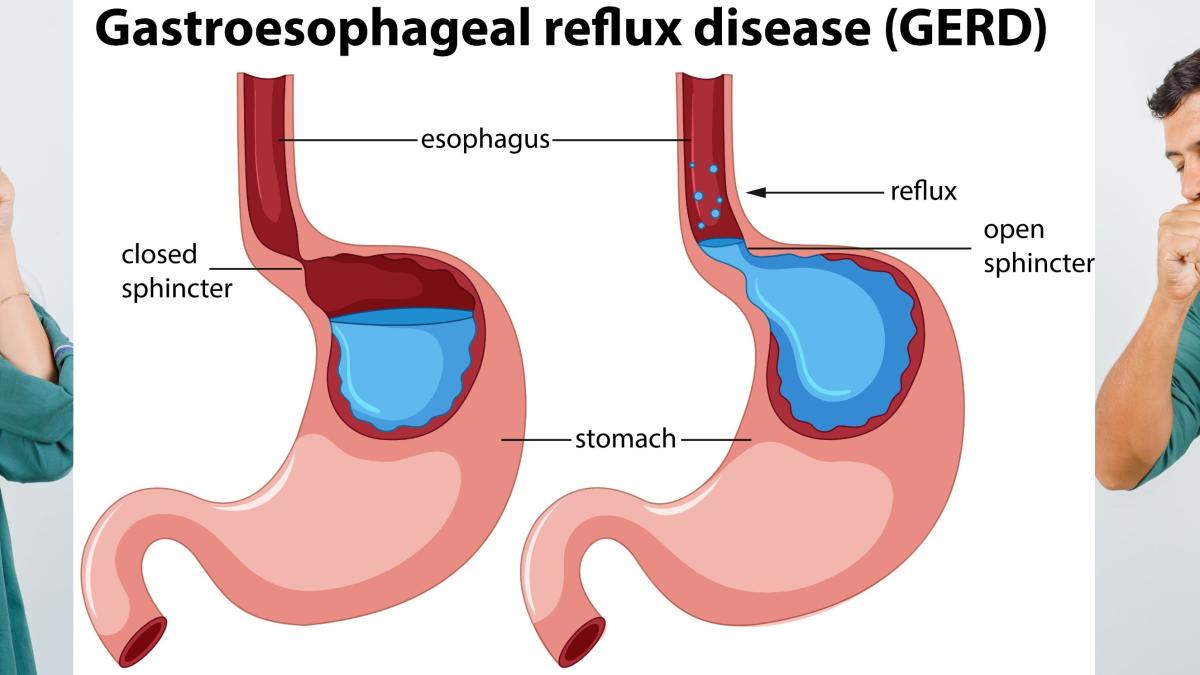 care-sunt-simptomele-refluxului-gastroesofagian-si-ce-sa-te-trimita-urgent-la-medic--buliga-oamenii-tusesc-si-nu-stiu-de-ce_57442700