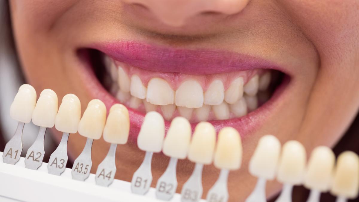 fatete-dentare--avantaje-si-dezavantaje--se-pun-doar-de-frumusete-sau-aduc-vreun-beneficiu-iancu-acesta-este-singurul-dezavantaj_59394100