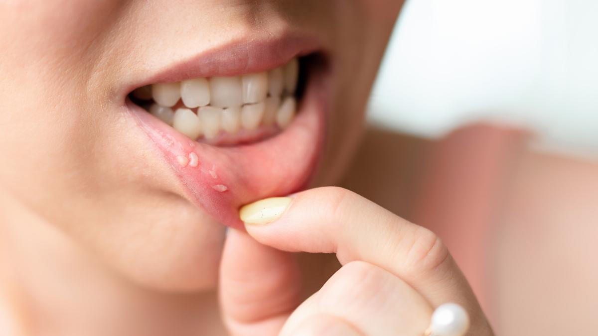 afte-in-gura--simptome--tratament-si-de-ce-apar--3-remedii-naturiste-care-le-fac-sa-dispara_05869300