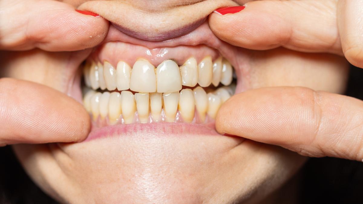 retragerea-gingivala--ce-este--simptome--cauze--tratament--iancu-semn-al-imbolnavirii-osului--nu-trebuie-neglijata_40095600