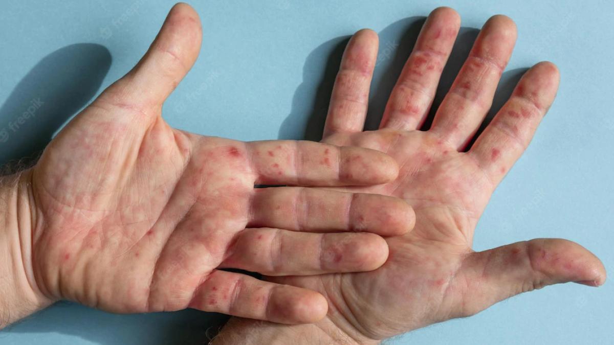 eczema-dishidrotica-simptome-si-tratament--stresul--unul-dintre-factorii-de-risc_37422800